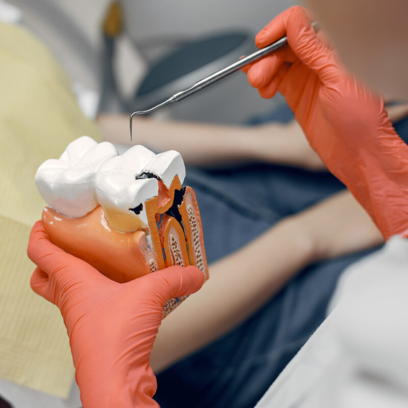 Root Canal Treatment: Menyelamatkan Gigi dari Infeksi Serius